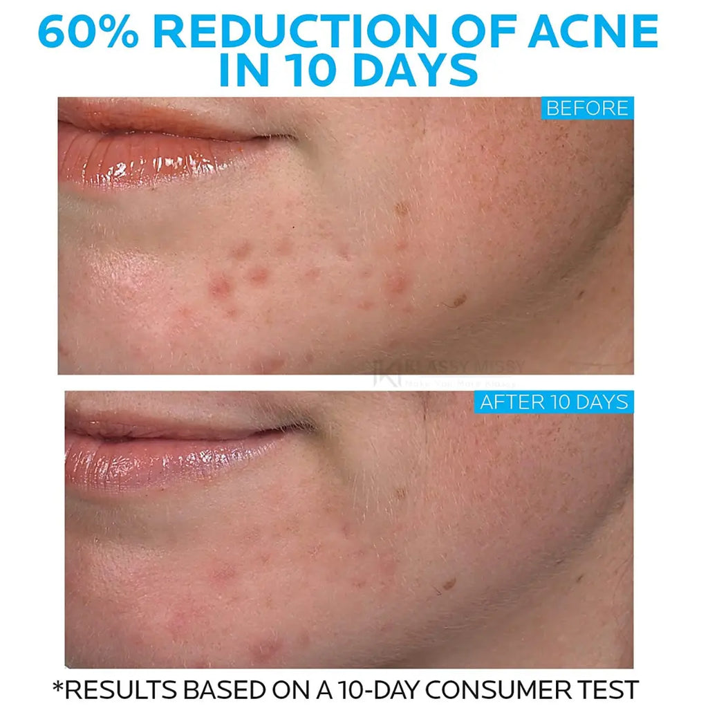 La roche posay effaclar duo acne spot treatment in pakistan | ColorShow